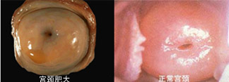 宫颈肥大的图片