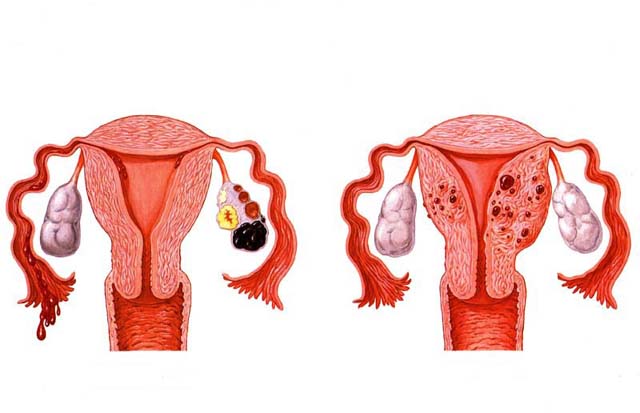 女性子宫内膜异位症有什么危害
