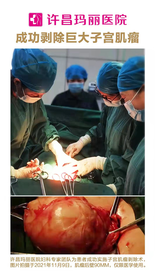 许昌玛丽医院成功剥除巨大子宫肌瘤