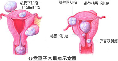个类型子宫肌瘤示意图